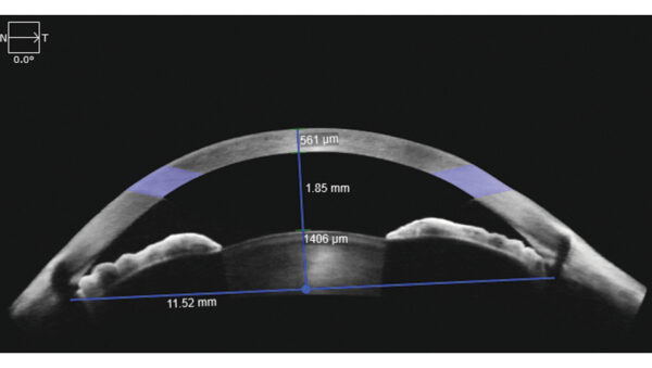 OCT-A CIRRUS® 6000 nueva generación de OCT de ZEISS. - Imagen 2