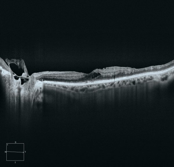 OCT-A CIRRUS® 6000 nueva generación de OCT de ZEISS. - Imagen 4